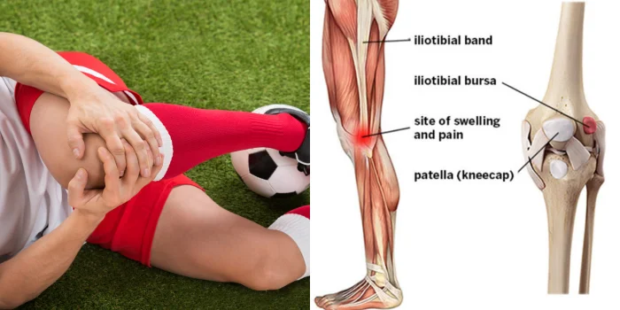 Iliotibial Band (ITB) Syndrome From Soccer.