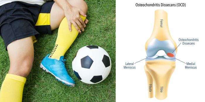 Osteochondral Defects From Soccer.
